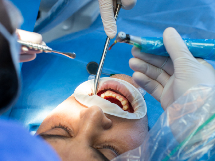 Cirurgia Oral Menor